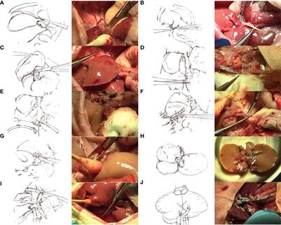 Preliminary study of donor volume changes after dual-graft liver transplantation in rats